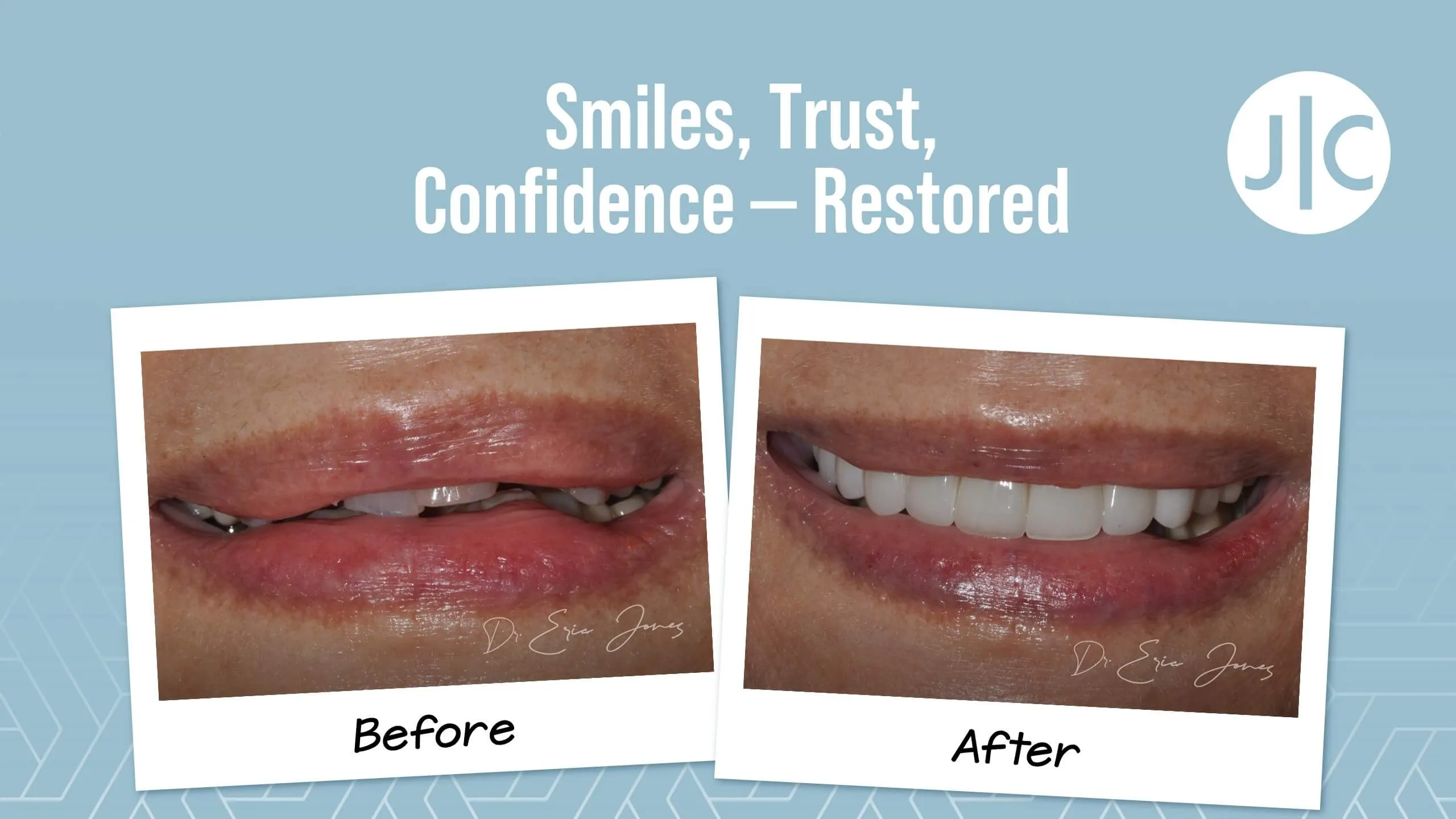 Smile makeover before and after