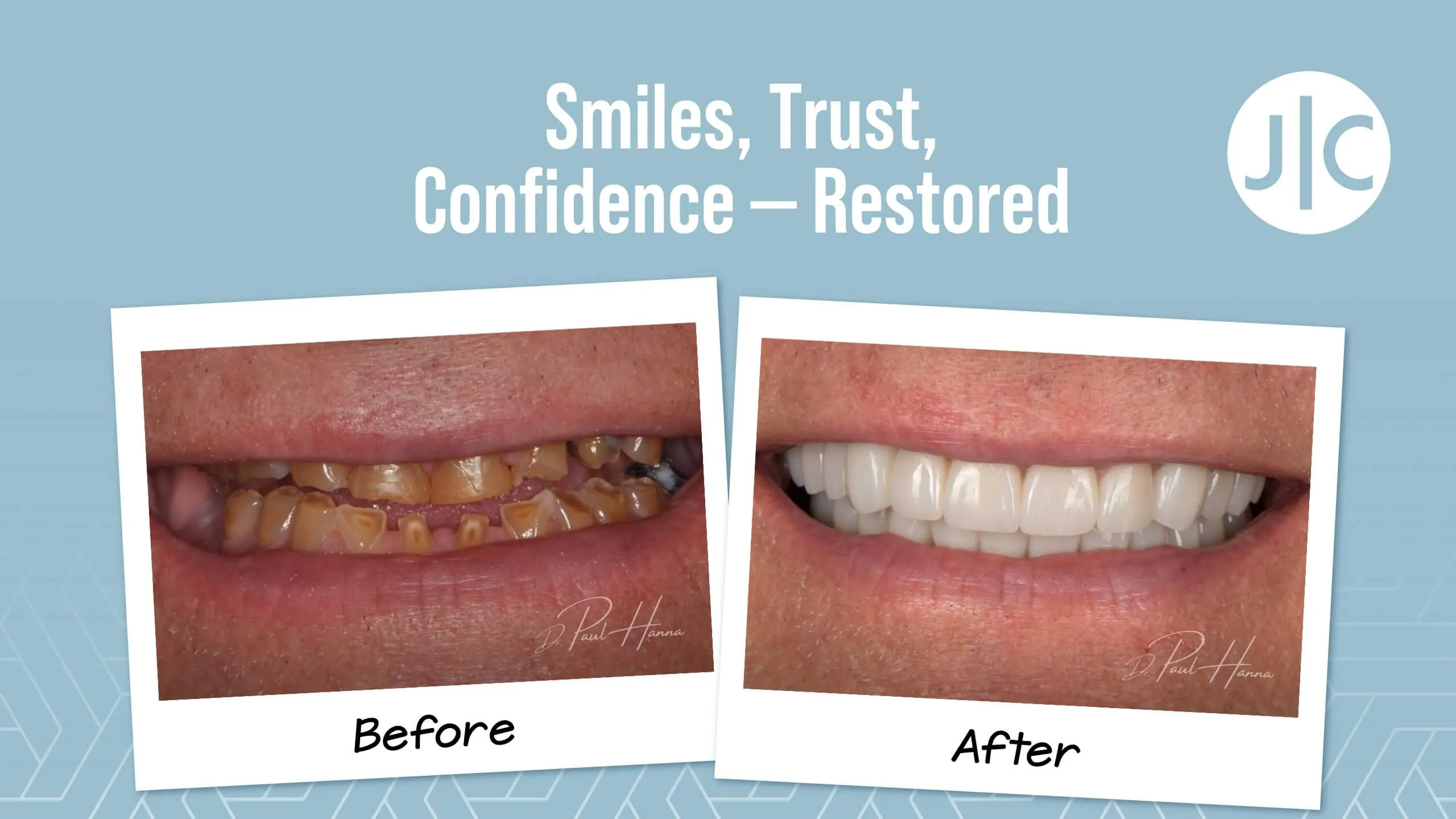 Dental implants before and after