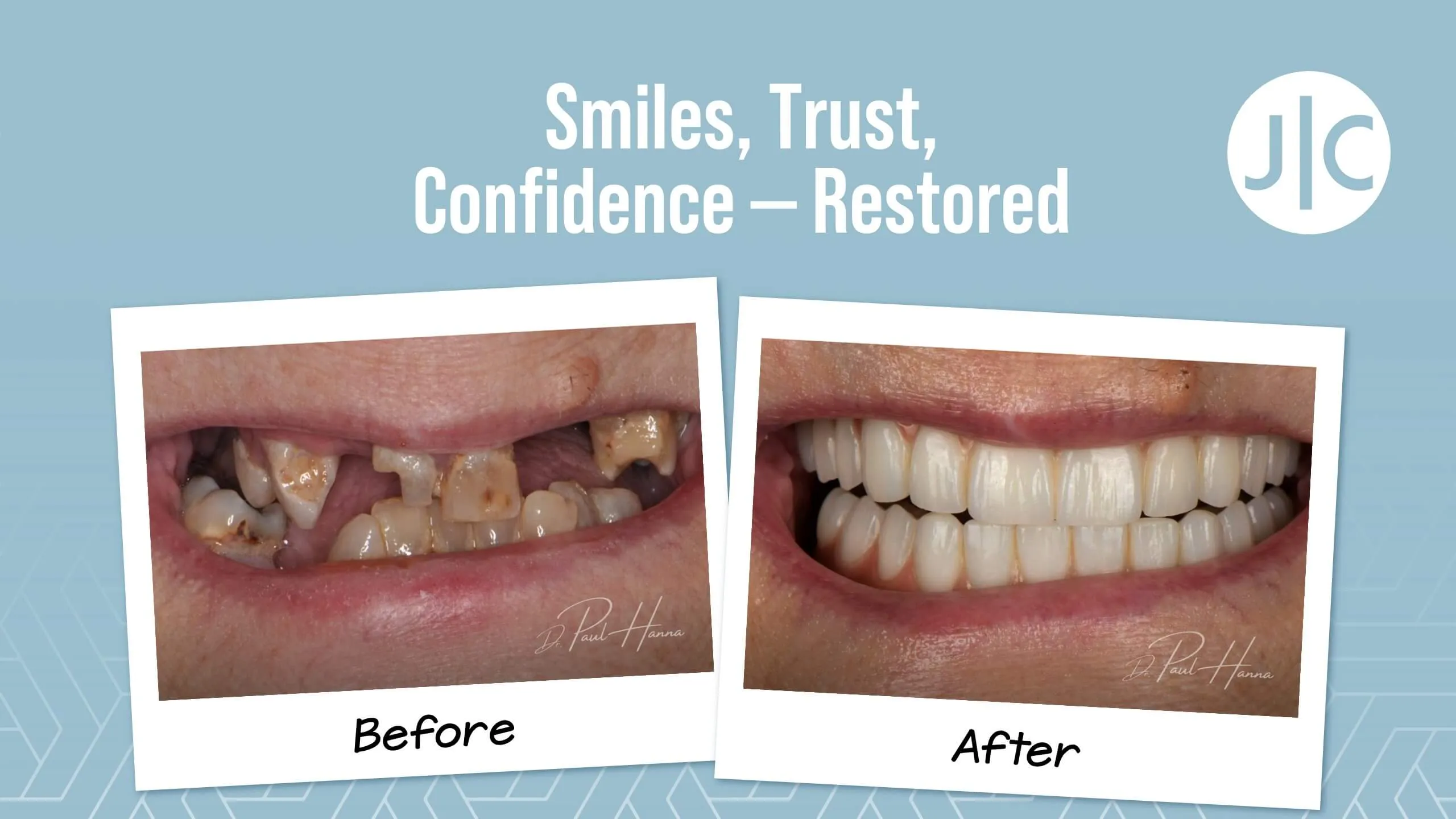 Veneers before and after
