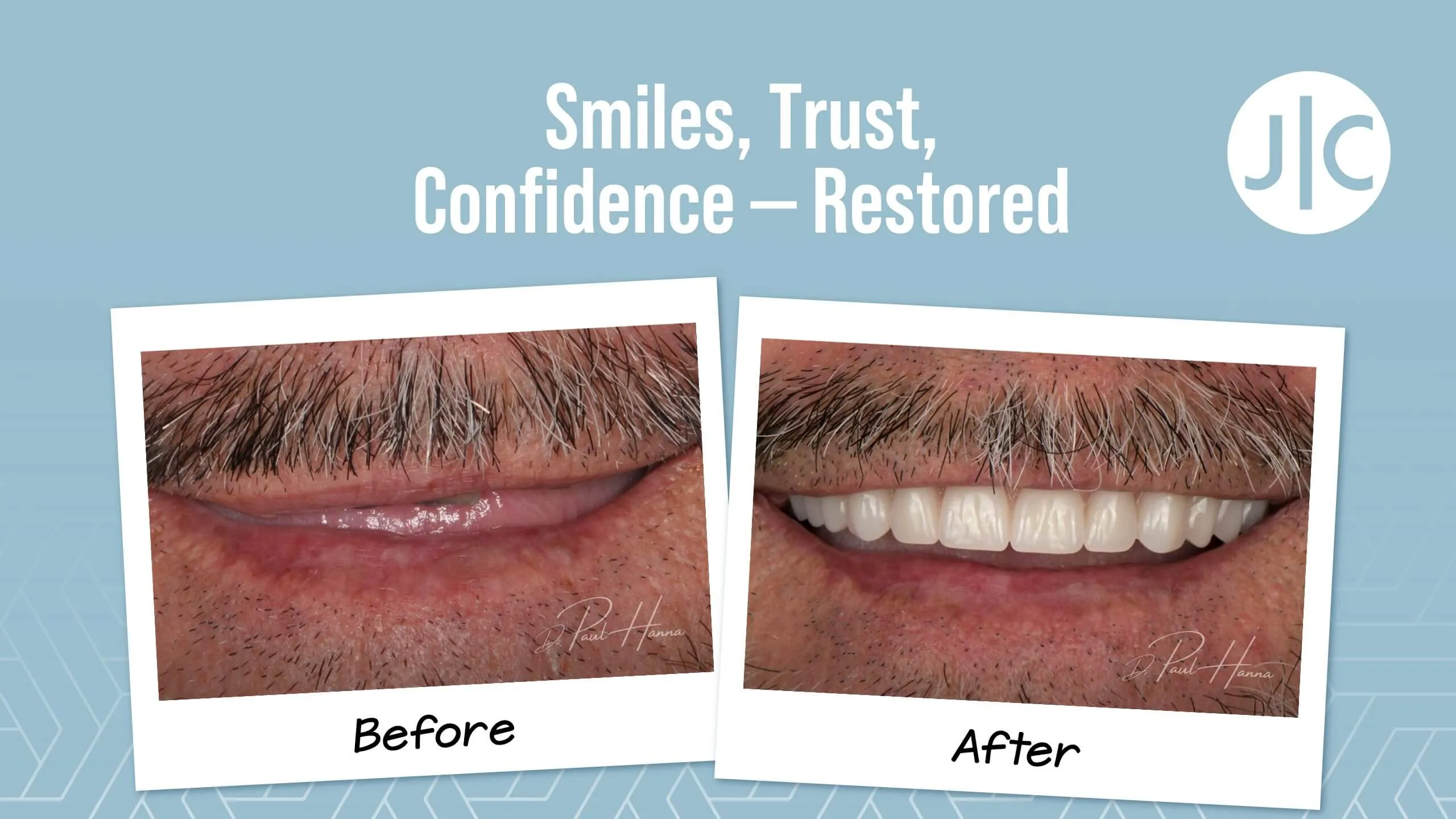 Smile transformation before and after